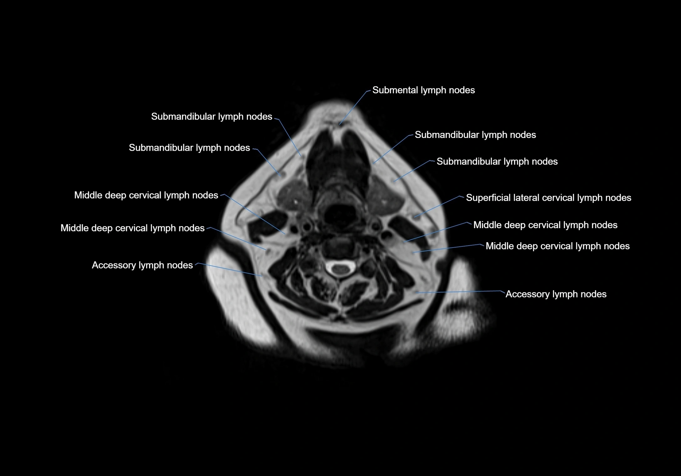Neck axial  lymph node cross sectional MRI anatomy 3T MRI  image-img-00001-00055.webp